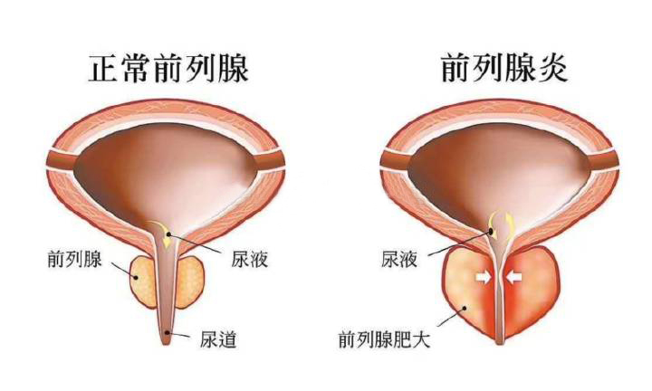 前列腺炎最新研究突破，開啟未來治療新篇章